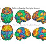 Wie die Tiefe Hirnstimulation das Denken und Erinnern bei Alzheimer- und Parkinson-Erkrankung beeinflusst
