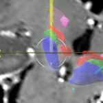 Patienten-Infonachmittag zur Tiefen Hirnstimulation am 14. Oktober im Uniklinikum Würzburg