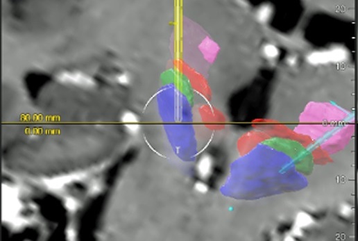 Patienten-Infonachmittag zur Tiefen Hirnstimulation am 14. Oktober im Uniklinikum Würzburg