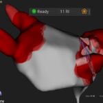 Vorhofflimmern: 3D-navigierte Anwendung von Pulsed Field Ablation am Uniklinikum Würzburg
