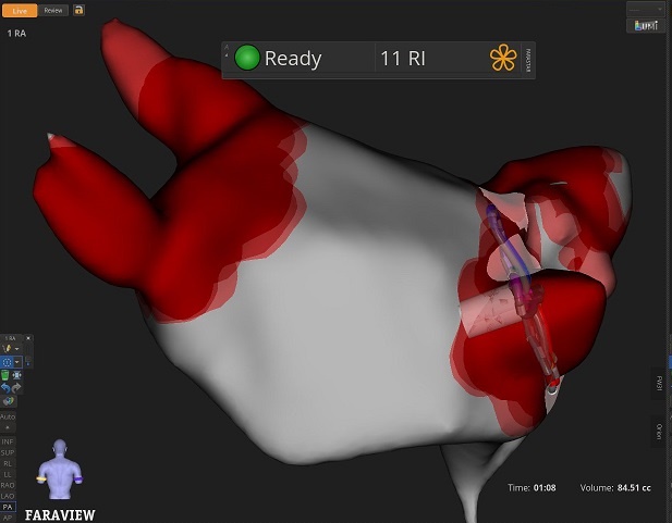 Vorhofflimmern: 3D-navigierte Anwendung von Pulsed Field Ablation am Uniklinikum Würzburg