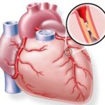Infoabend am Uniklinikum Würzburg: Gesunde Gefäße – gesundes Herz