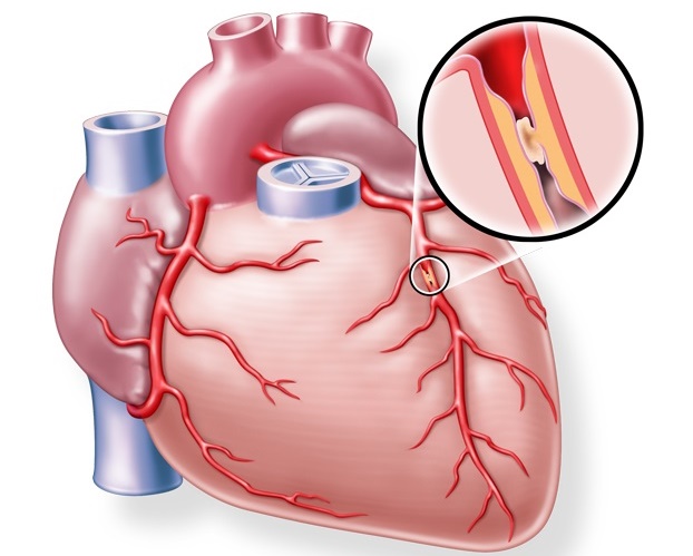 Infoabend am Uniklinikum Würzburg: Gesunde Gefäße – gesundes Herz