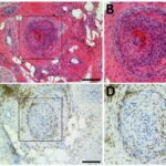 DECIPHER will die Mechanismen von chronischem Schmerz bei Neuropathien entschlüsseln