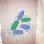 Neuer Therapieansatz bei chronischen Wunden mit probiotischen Bakterien