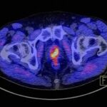 Kostenlose Veranstaltung: Infotag zum Thema Prostatakrebs am Uniklinikum Würzburg