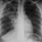 Welt-Tuberkulose-Tag: Würzburger Kolloquium beleuchtete regionale und globale Herausforderungen