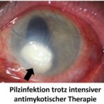 Wenn Pilze das Auge bedrohen: Pilzkeratitis besser verstehen und behandeln, DFG fördert interdisziplinäres Forschungsprojekt am UKW