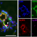 Neue Perspektive für die Schlaganfalltherapie: Neuroprotektion durch Blockade von NLRP3 in der Akutphase